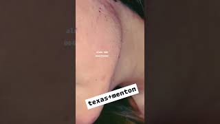 texas+menton 0663175991 #meknes #اكسبلور #texas #cheekfillers