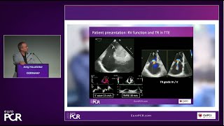 A patient-focused transcatheter portfolio of options to treat tricuspid regurgitation - EuroPCR 2022