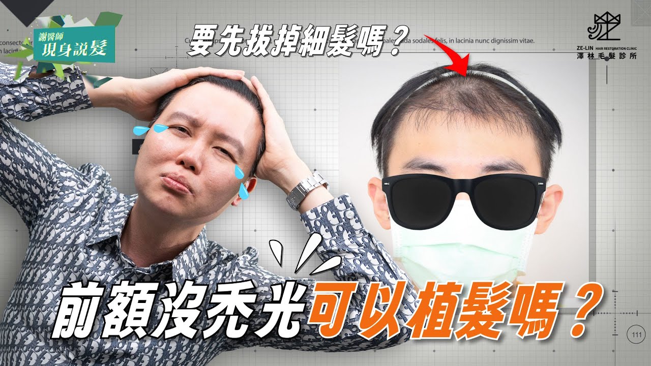 前額稀疏可以植髮嗎？謝醫師怎麼評估｜謝宗廷醫師