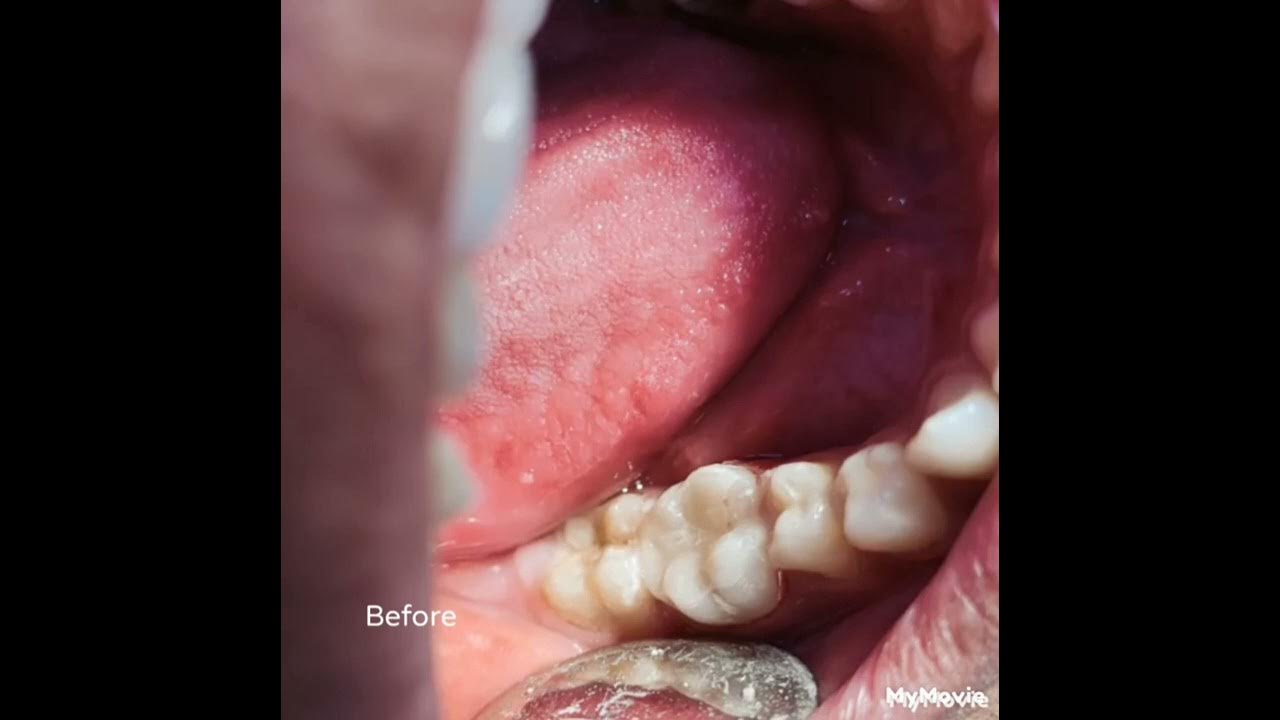 composite build up with 46tooth color restoration tooth filling