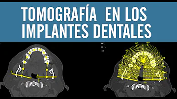 ¿Los implantes dentales requieren un TAC?