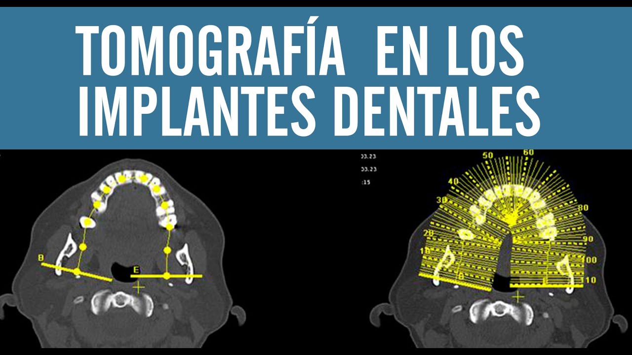 La importancia de la tomografía  en los implantes dentales |  Juan Fernando Salgado
