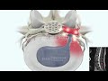 Laser Spine Surgery for Discogenic Low Back Pain from Herniated Disc L4-L5, L5-S1