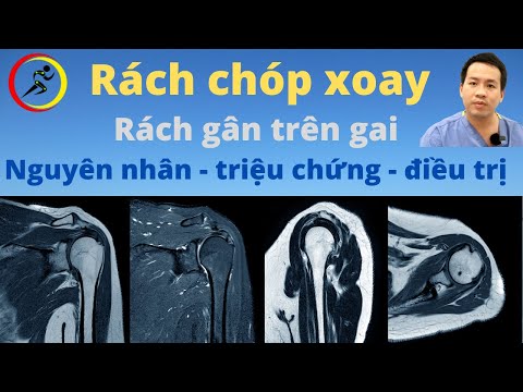 Rách chóp xoay là gì? Rách gân cơ trên gai - nguyên nhân, triệu chứng và cách điều trị?