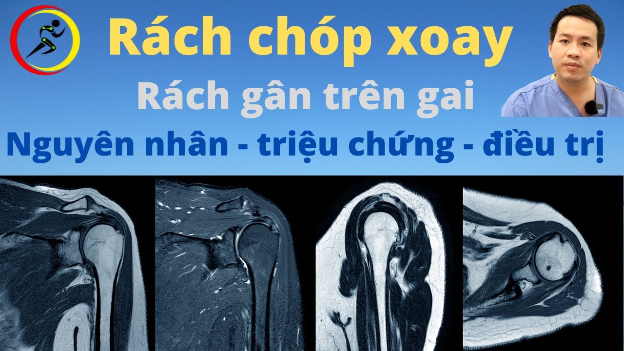 Rách chóp xoay là gì? Rách gân cơ trên gai - nguyên nhân, triệu chứng ...