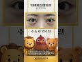 #ザビビ整形外科 👁目元の印象を変える、トリプル目元整形（目頭＋目尻＋目下切開）