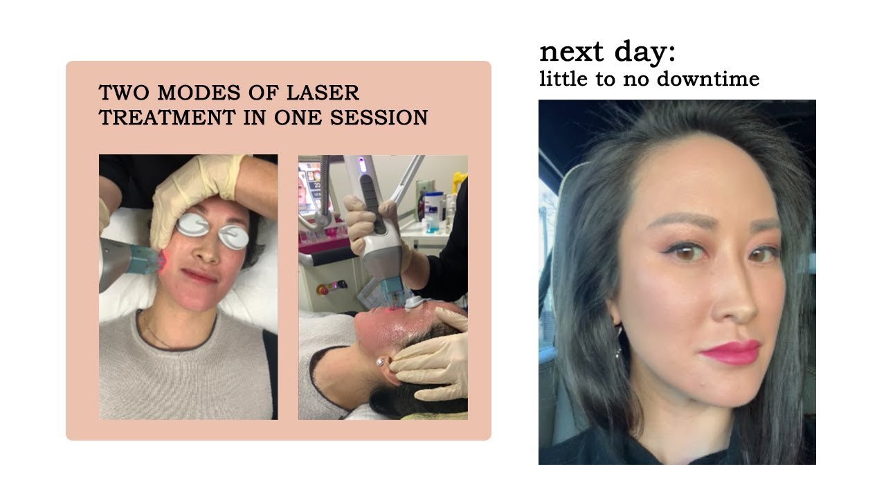 MOSAIC (Erbium Glass) non-ablative skin rejuvenating laser treatment