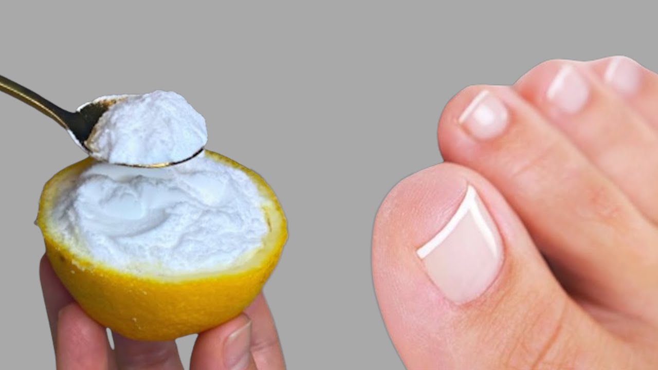 Do you suffer from nail fungus? Toenail Fungus Removal 100 Natural