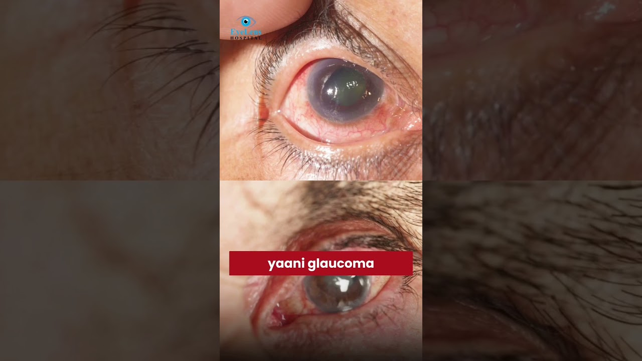 Glaucoma |  The SILENT THIEF Stealing Your Sight | (and a Simple Trick to Fight Back!) | #glaucoma