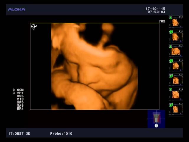 3D-4D плода 31 неделя беременности