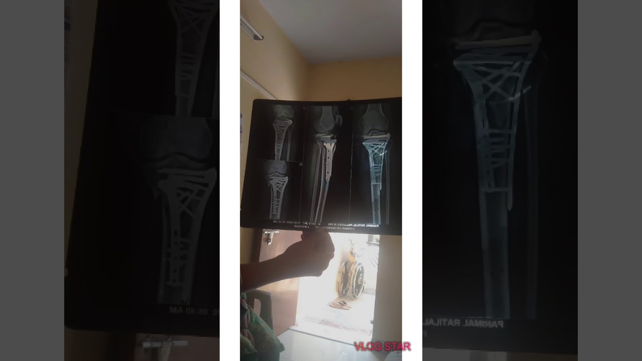 Leg fractured exercise YouTube