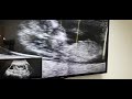 11 semanas de embarazo ecografía / bebe saltando