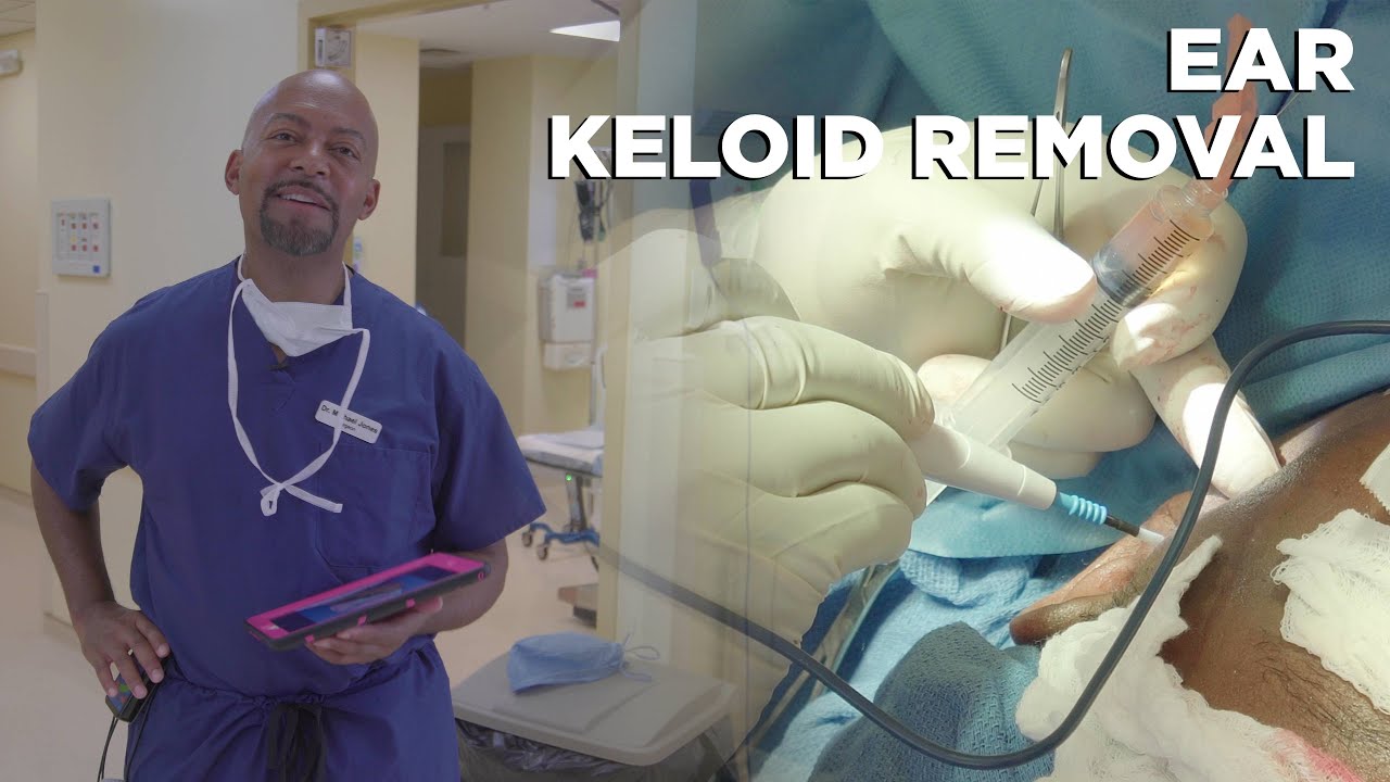 PATIENT HAS KELOIDS ON BOTH EARS YouTube