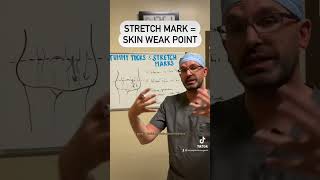 Famous Do Tummy Tucks Remove Stretch Marks? | Butts By Design Net Worth