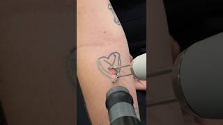 FIRST Session Laser Tattoo Removal SNAP ASMR #tattooremoval #lasertattooremoval #tattoo #regret #pov
