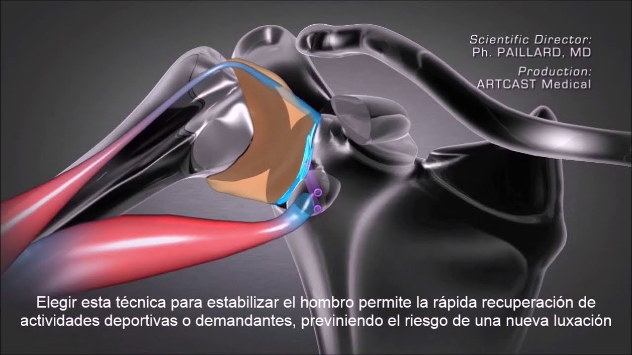 Cirugía Luxación Hombro. Shoulder Instability Surgery.