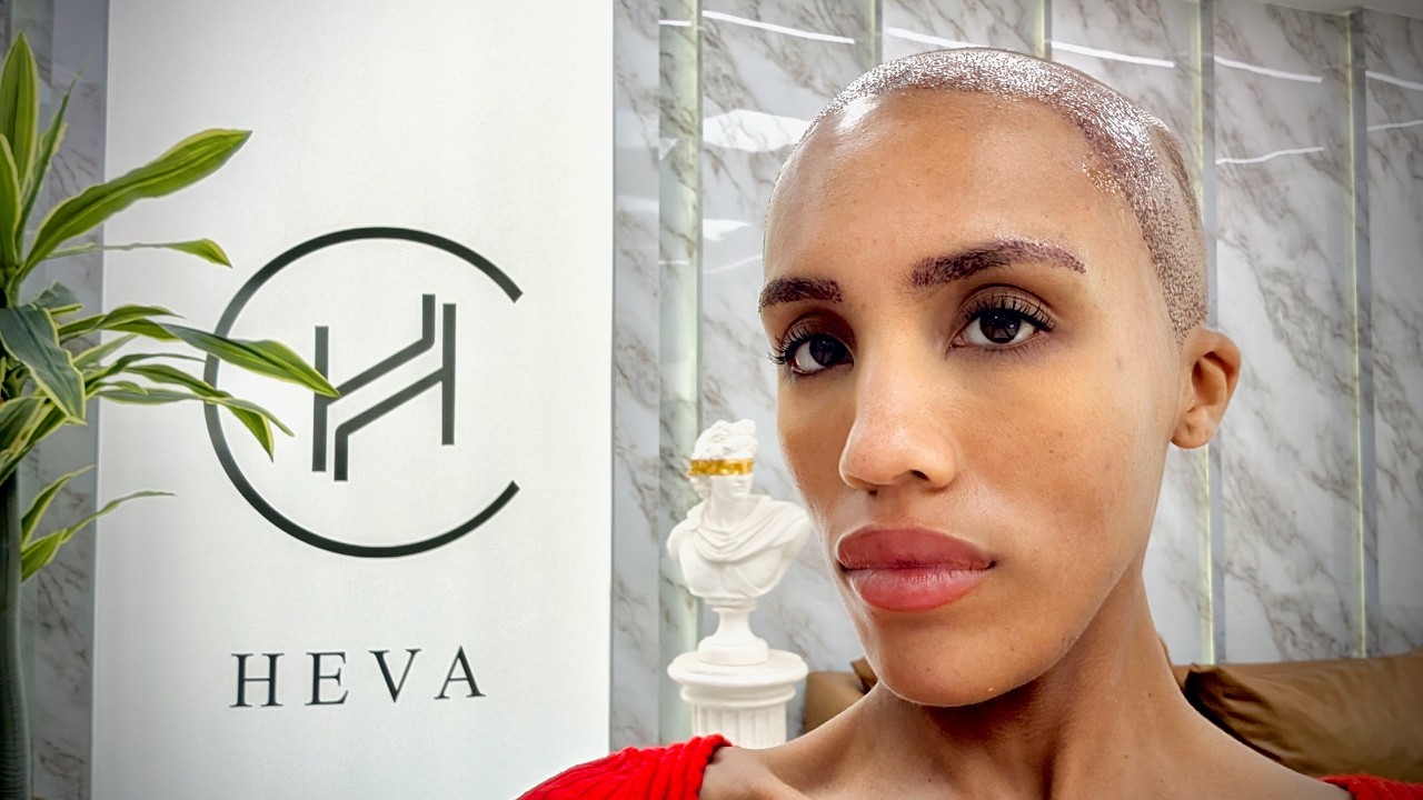 I Went to Turkey for a Hair Transplant at Heva Clinic... Regrets? Pt1