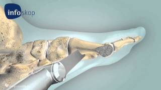 3D medical animation - Osteotomy - Hallux Valgus - designidentity