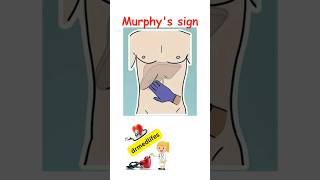 Murphy's sign acute cholecystitis