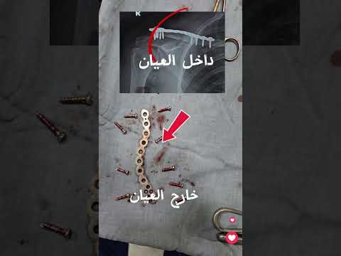 الشريحه والمسامير داخل وخارج المريض