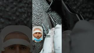 کاشت مو رو از زاویه نزدیک ببین .بدون درد با طراحی خط رویش متناسب با فرم صورتتراکم بالا.