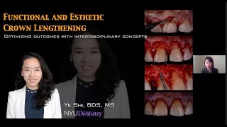 Esthetic Crown Lengthening By  Dr Ye Shi screenshot 4