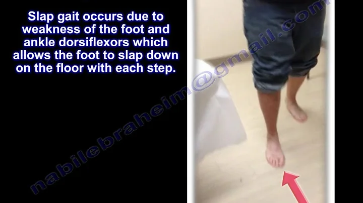 Slap gait , Steppage Gait . Foot Drop - Everything You Need To Know - Dr. Nabil Ebraheim - DayDayNews