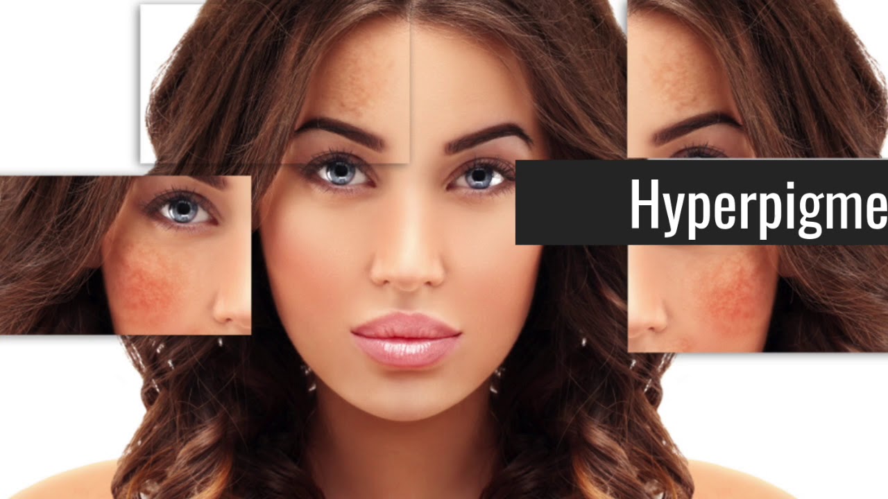 BBC Interview with Laserderm