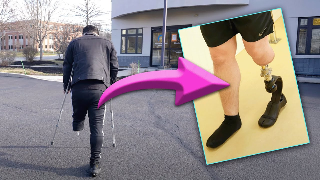 First Prosthesis Fitting | Post-Surgery 🤯