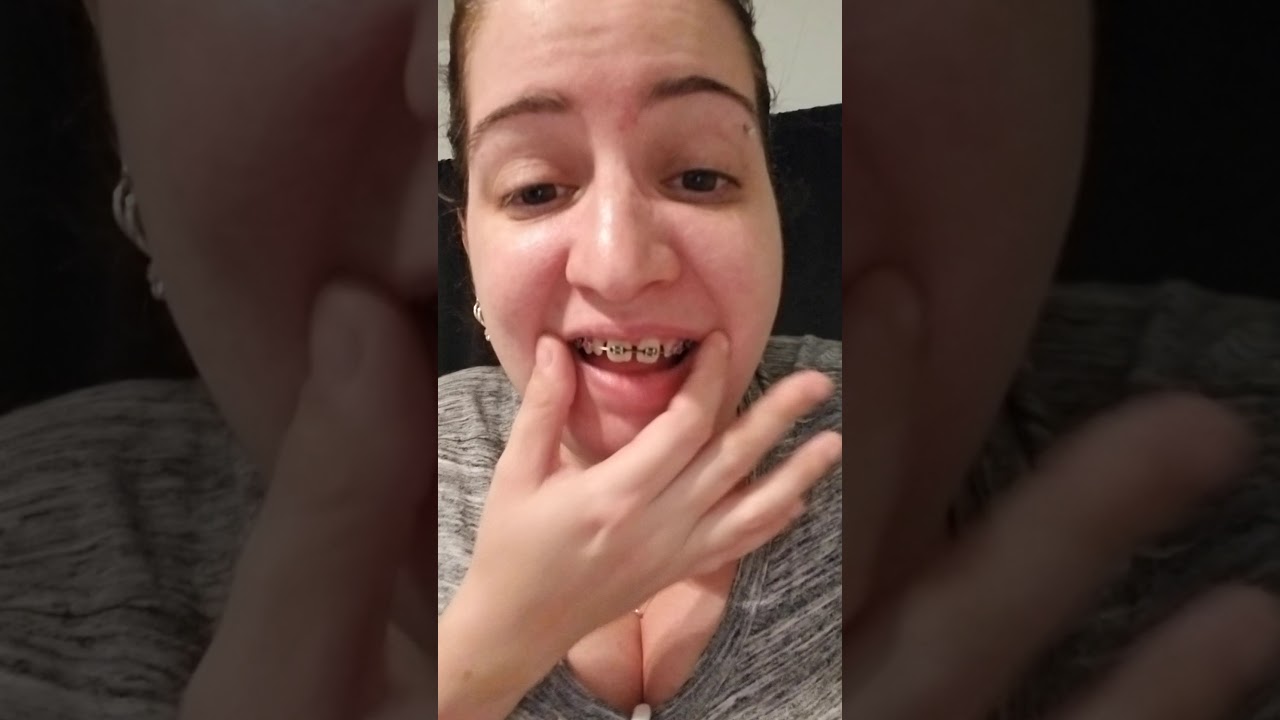 Braces journey update for August! 