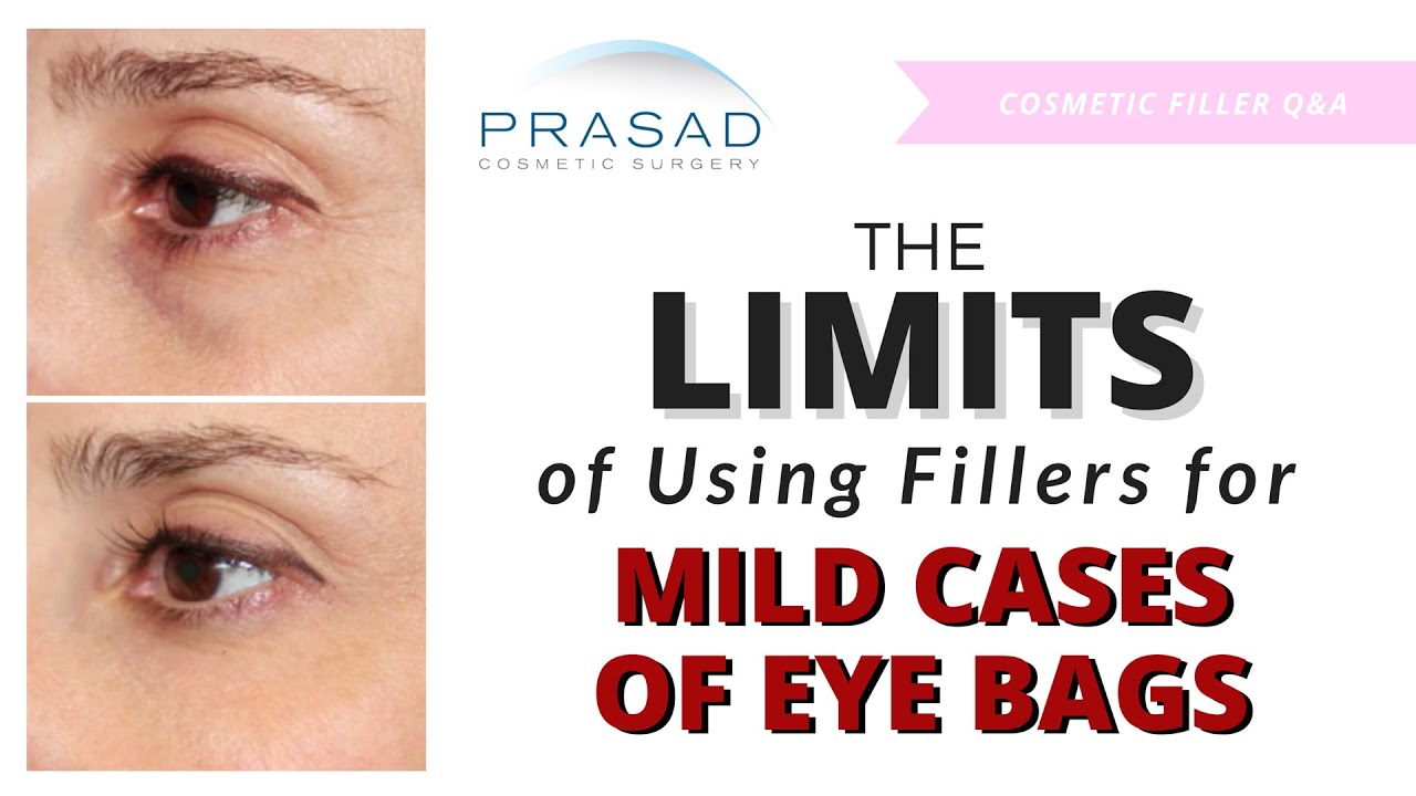 Get Under Eye Filler For Hollow Eyes Tear Troughs And Under Eye Bags HD Get Wallpaper Under Eye Filler For Hollow Eyes Tear Troughs And Under Eye Bags HD