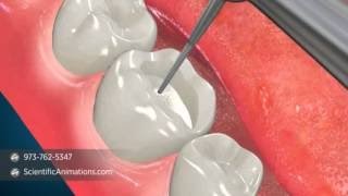 Dental Inlay - Tooth Restoration Procedure