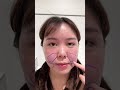 【小顔整形】脂肪吸引経過お見せします✨#shorts