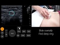 Ultrasound tutorial inguinalfemoral hernia assessment  radiology nation