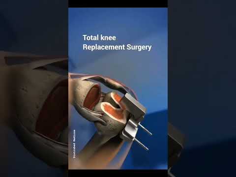 Total Knee Replacement|
