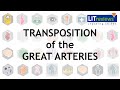 Transposition of The Great Arteries