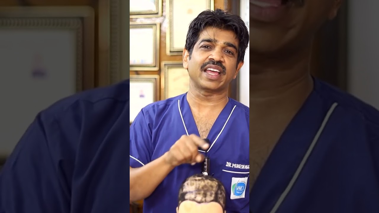 Side Effect Of Stress on Hair! Facts of Hair Fall!