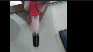 Celebrity Case Report of Hypertriglyceridemia Net Worth