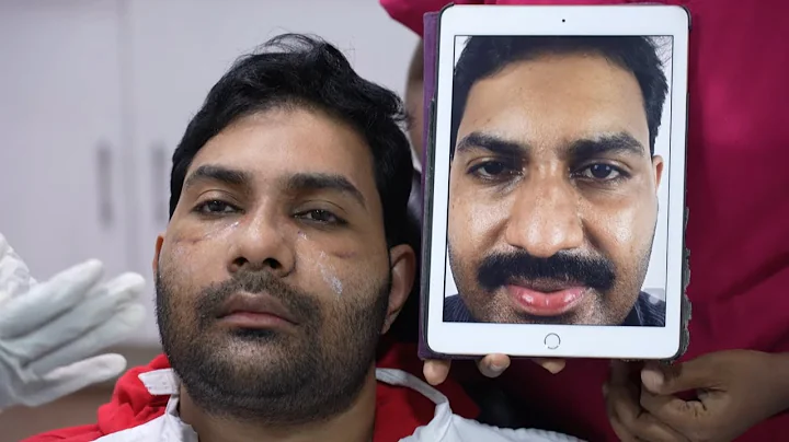 Broad Nose Men Rhinoplasty | Indian Nosejob Amazin...