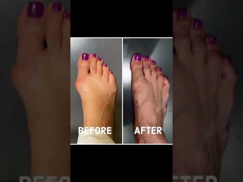 These Bunions Get A Bonita Transformation With AMI® Bunion