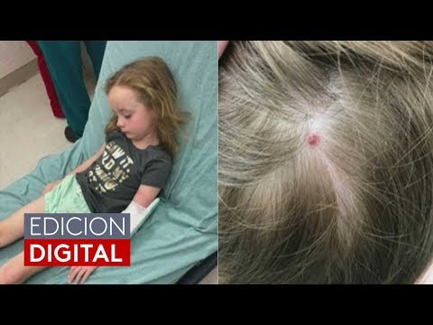 Video: Mordido Por Una Garrapata: ¿qué Hacer?