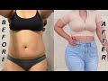 MY SURGERY RESULTS!!! | BBL REVEAL 🤪🍑