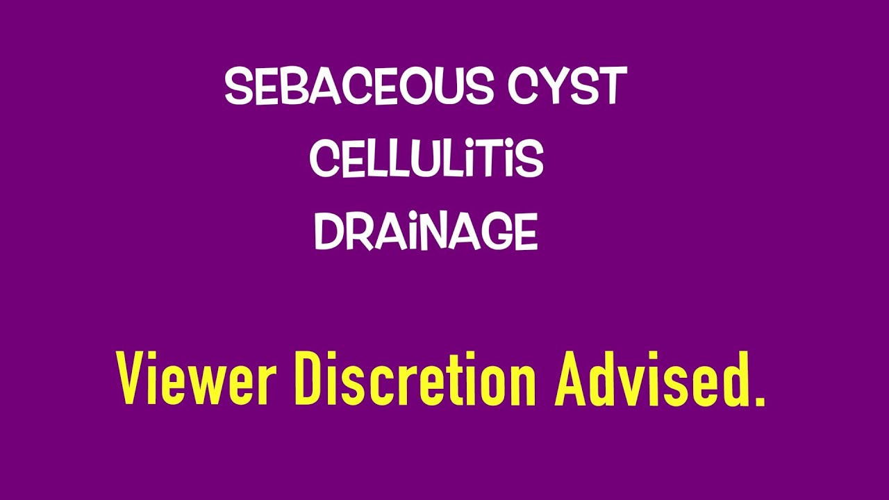 Sebaceous Cyst Medically Drained From Under Breast Cellulitis