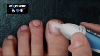 Excilor Tv Commercial 恢甲清 特別報告