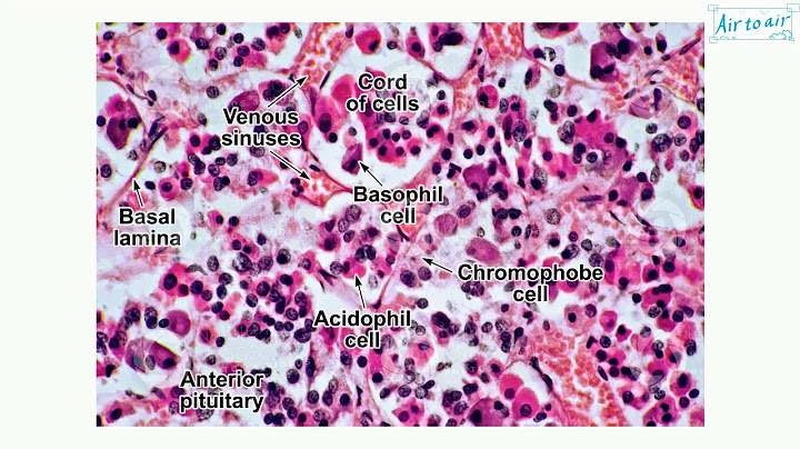 Chromophobe adenomas of the anterior pituitary là gì