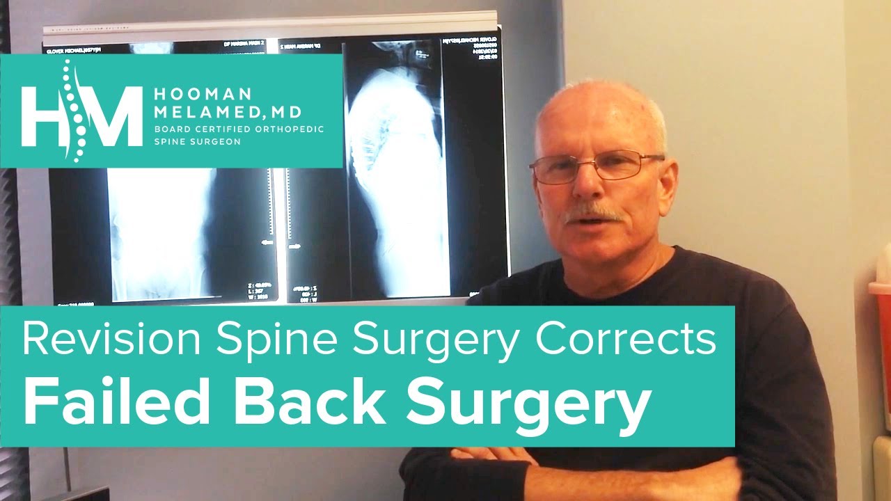 correcting-kyphosis-failed-back-surgery-the-spine-pro-youtube