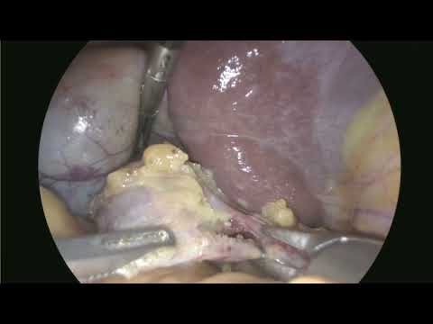 TORSION KOD & VB LITHIASIQUE SOUS COELIO
