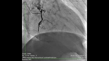 Complex PCI of sub-totally occluded RCA