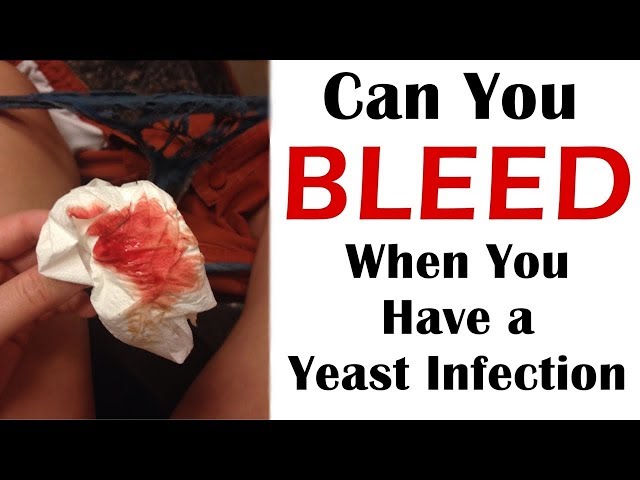 Can a Yeast Infection Cause Bleeding?