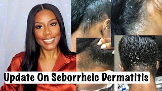 Do I still struggle with dry/flaky scalp {Seborrheic Dermatitis}? how I handle this condition